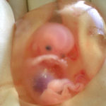Human_fetus_10_weeks_with_amniotic_sac_-_therapeutic_abortion