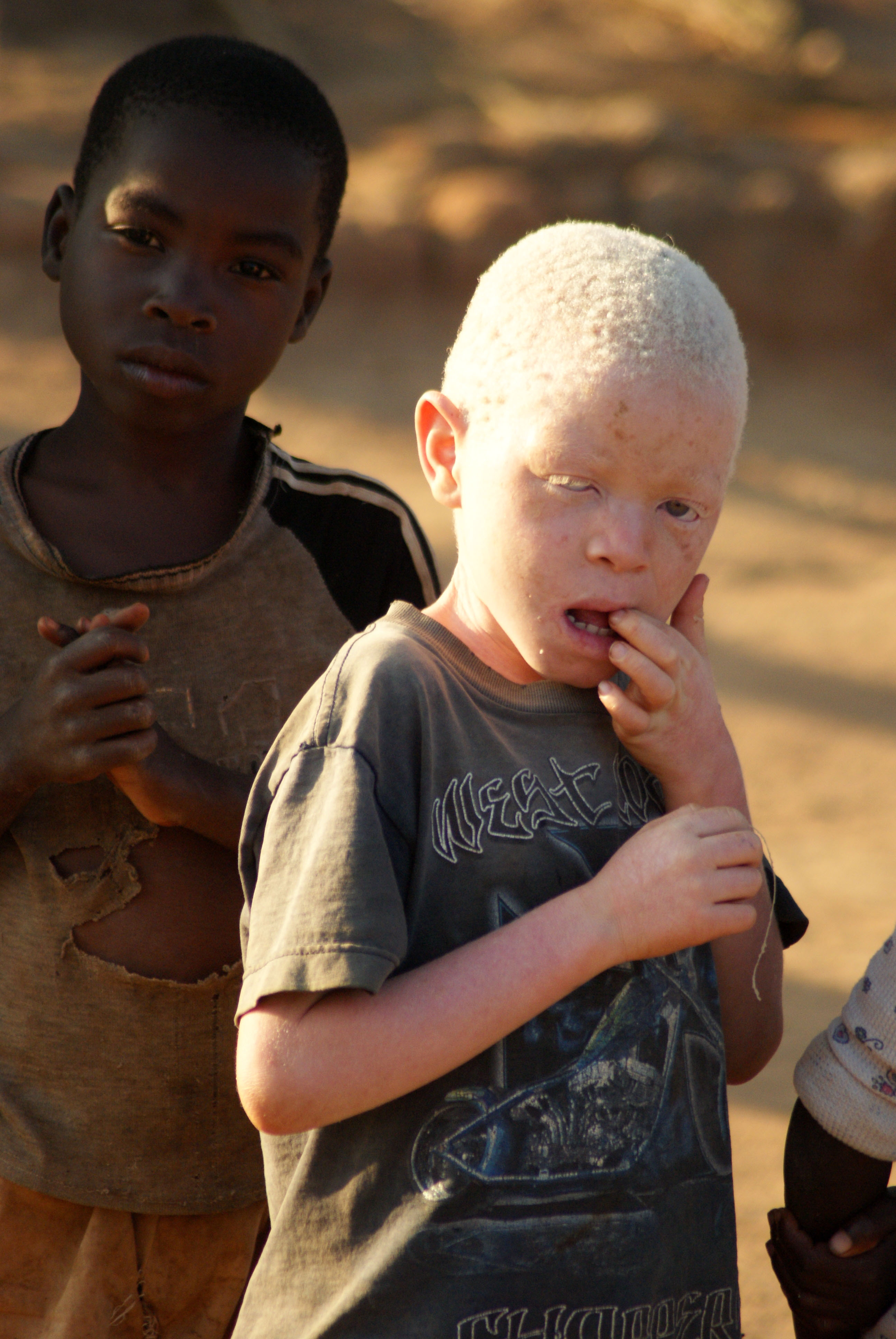 African Elites Hunt down Human Albinos to Eat Them in Satanic Rituals Resto...