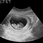 Pregnancy_ultrasound_110322105347_1056300